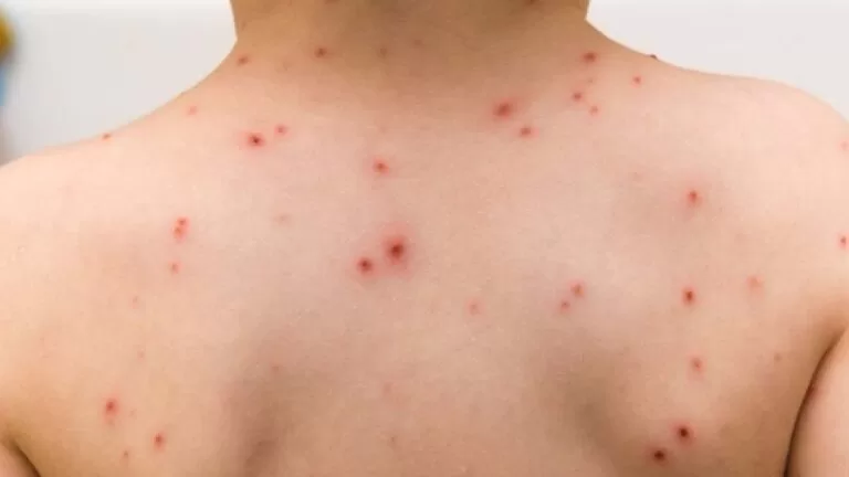 Saúde de Corumbá alerta sobre aumento de casos de catapora