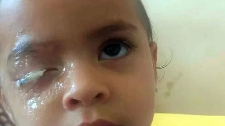 Após colar olho com super cola, criança de 2 anos precisa de cirurgia