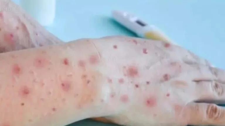 Bebê de dois anos testa positivo para varíola dos macacos em MS