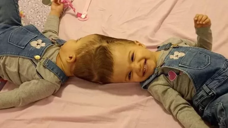 Gêmeas siamesas são separadas com sucesso após cirurgia de 25 horas em SP