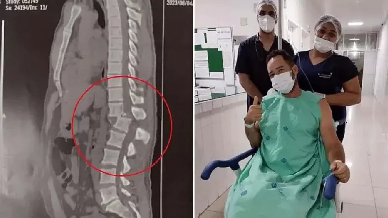 Atingido por equipamento em academia recupera sensibilidade nas pernas