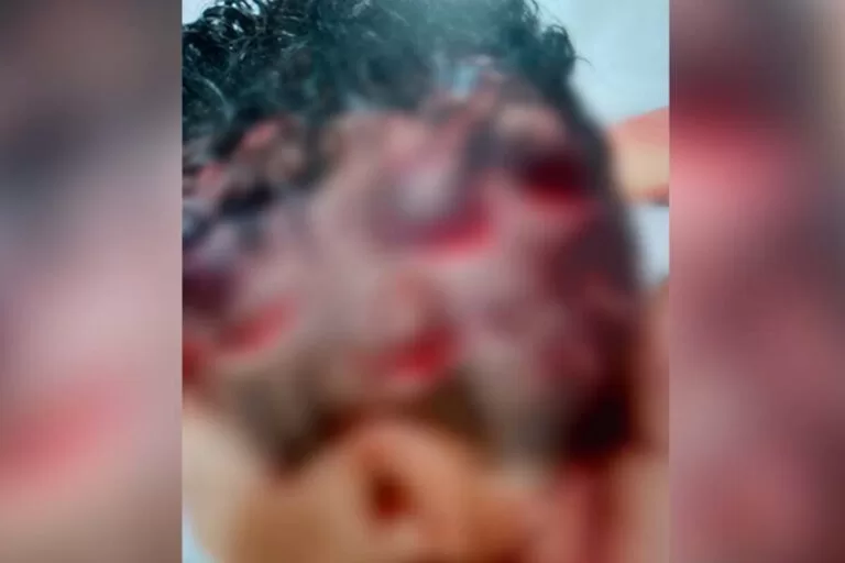 Menino de 4 anos é hospitalizado após ser atacado por capivara em Três Lagoas