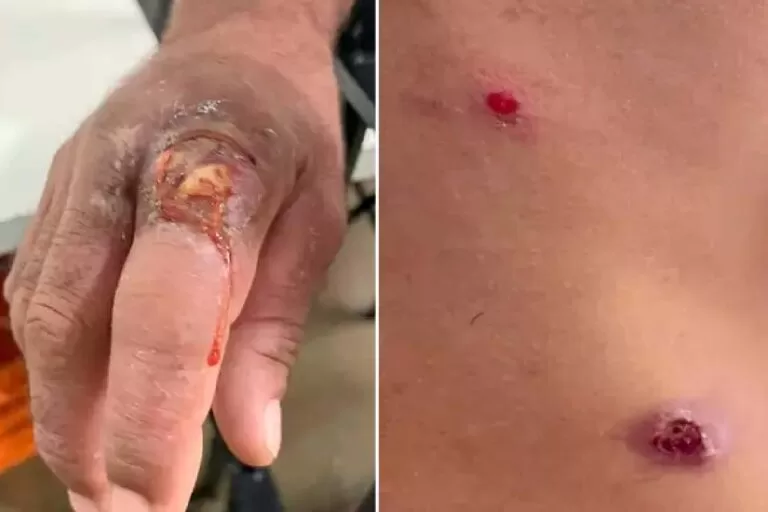 Com cerca de 500 casos, presídio em MS tem surto de sarna e furúnculo