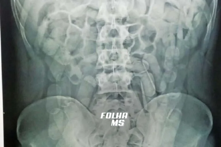 Boliviano é preso com 80 capsulas de cocaína no estomago em Corumbá