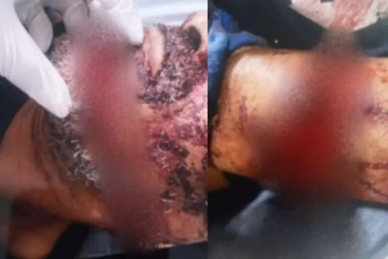 Homem tem mão amputada e rosto esfaqueado pela esposa em MS